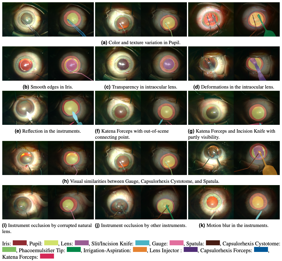  Visualization of pixel-based annotations corresponding to relevant anatomical structures and instruments in cataract surgery and the challenges associated with different objects.