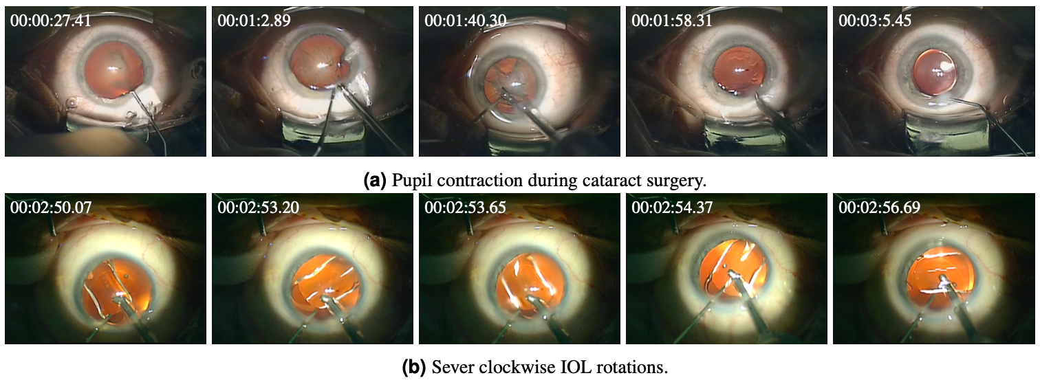 Intra-operative irregularities in cataract surgery.